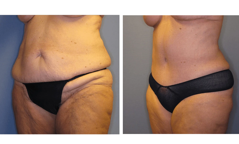 Tummy Tuck - Case 3 (3)