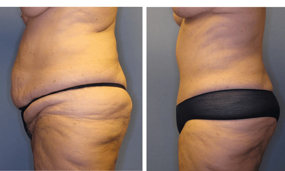 Tummy Tuck - Case 3 (4)