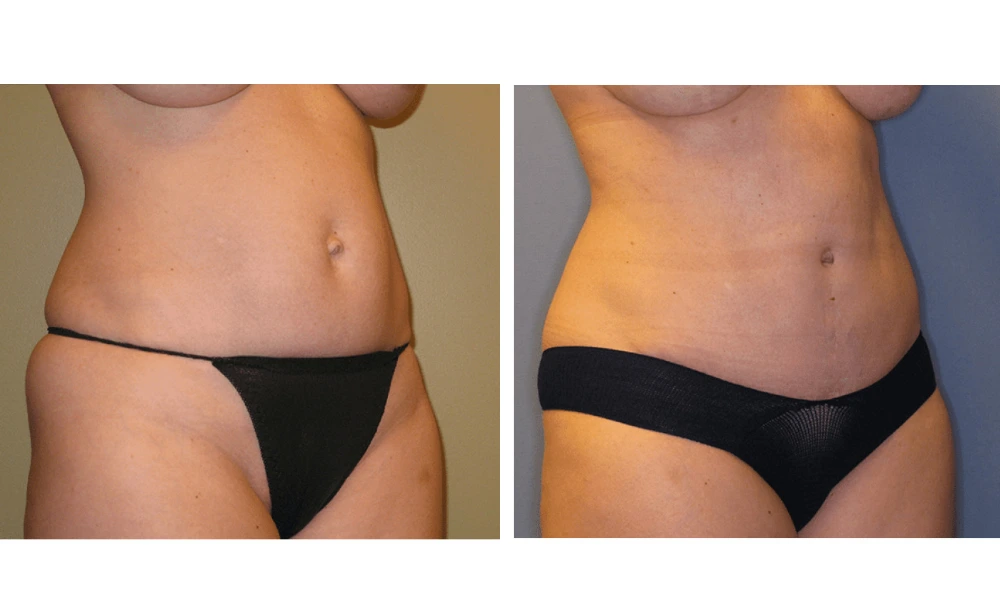 Tummy Tuck - Case 4 (1)