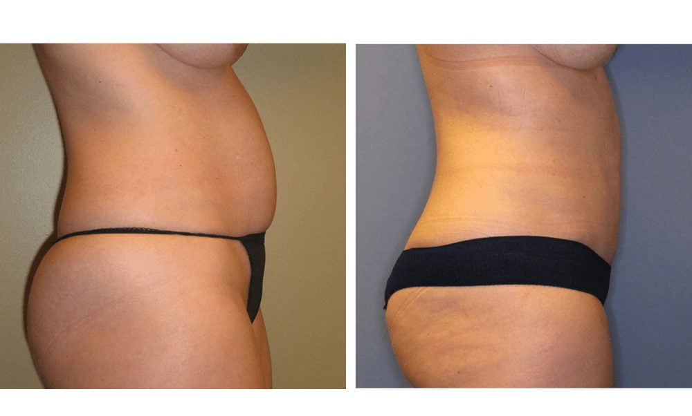 Tummy Tuck - Case 4 (2)