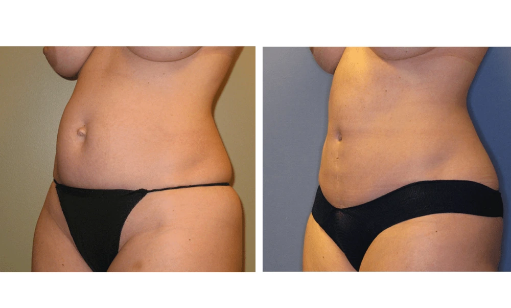 Tummy Tuck - Case 4 (3)