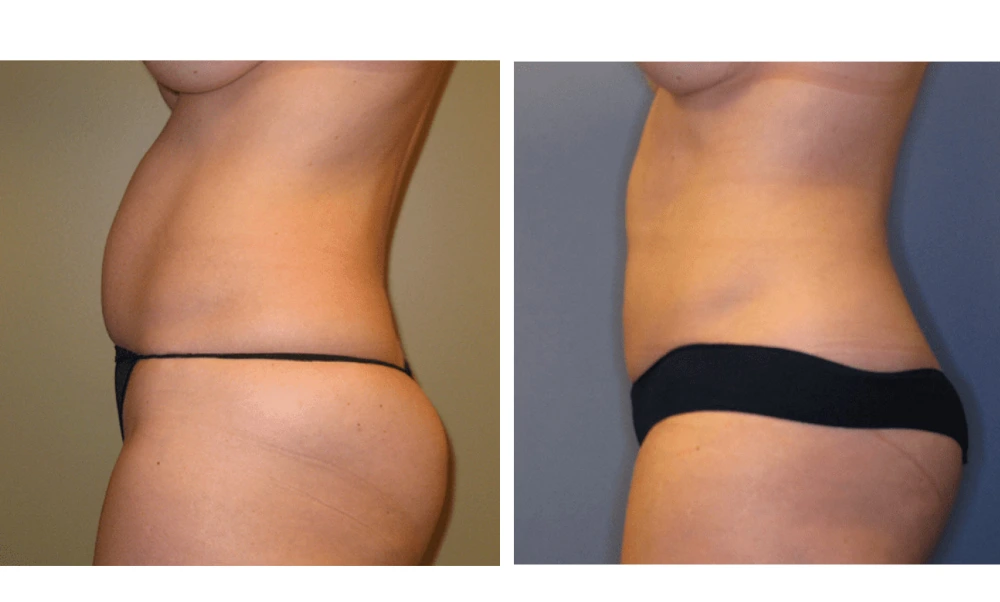 Tummy Tuck - Case 4 (4)