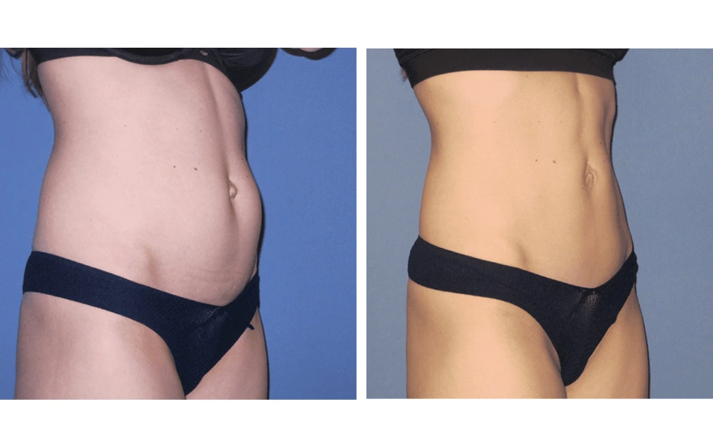 Tummy Tuck - Case 5 (1)