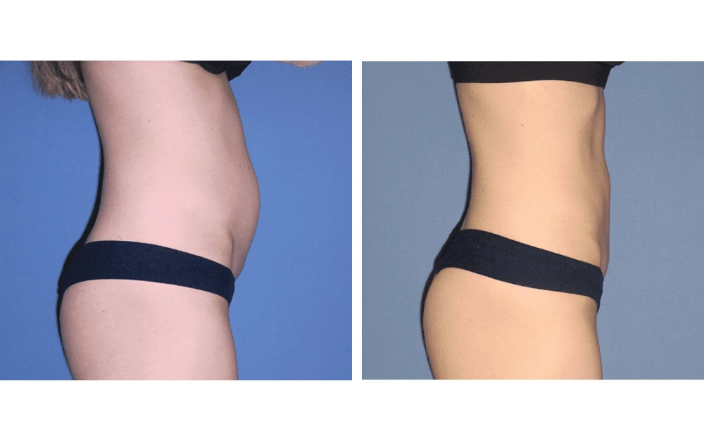 Tummy Tuck - Case 5 (2)