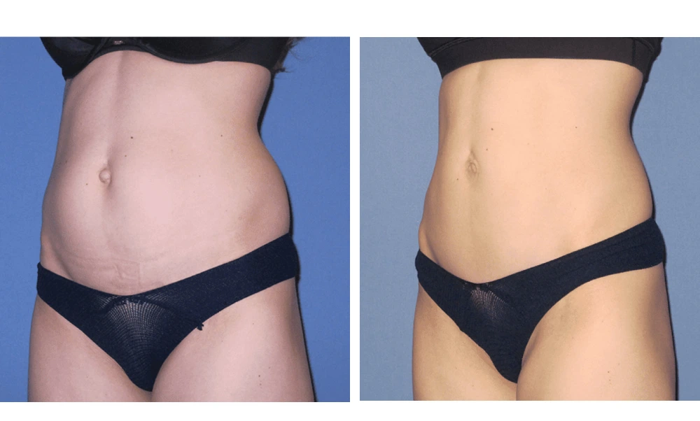 Tummy Tuck - Case 5 (3)