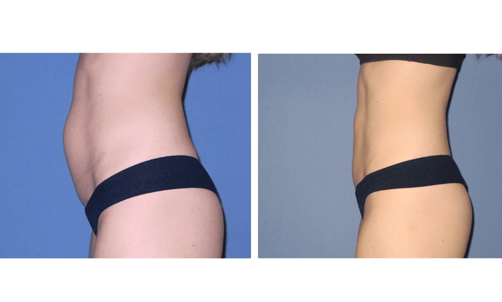 Tummy Tuck - Case 5 (4)