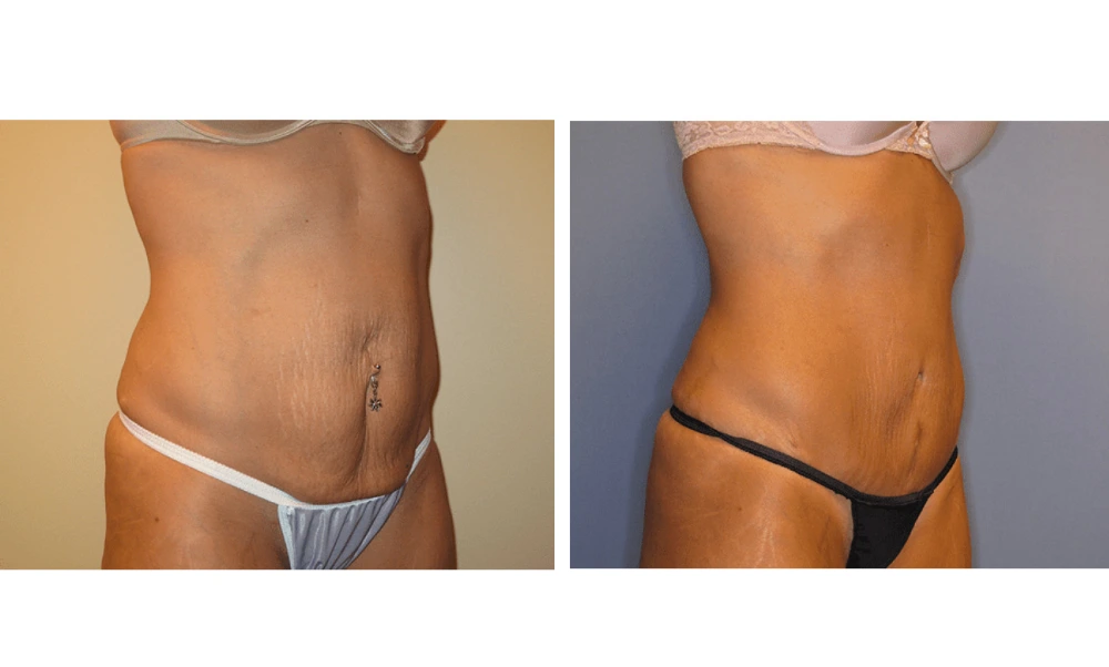 Tummy Tuck - Case 6 (1)