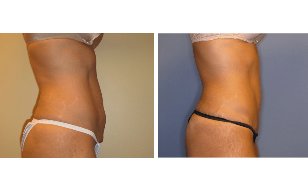 Tummy Tuck - Case 6 (2)