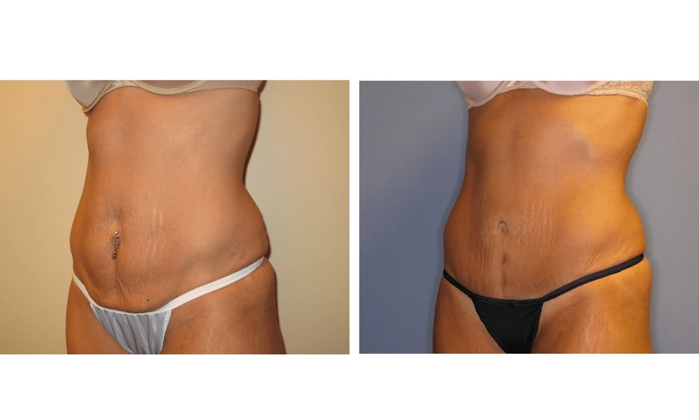 Tummy Tuck - Case 6 (3)