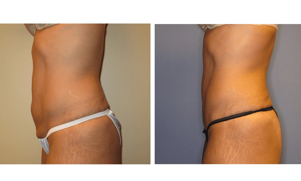 Tummy Tuck - Case 6 (4)