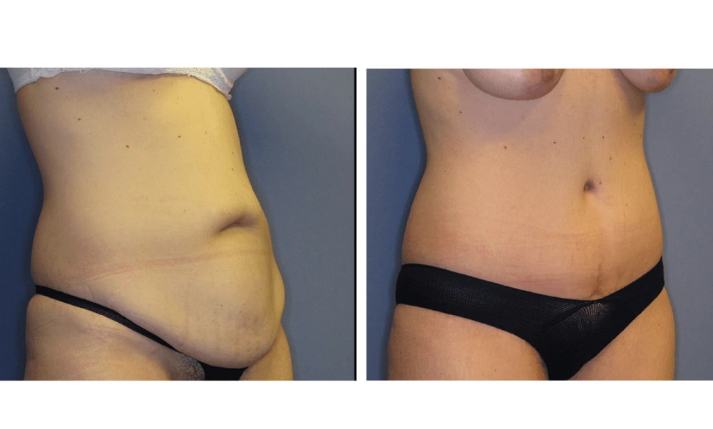 Tummy Tuck - Case 7 (1)