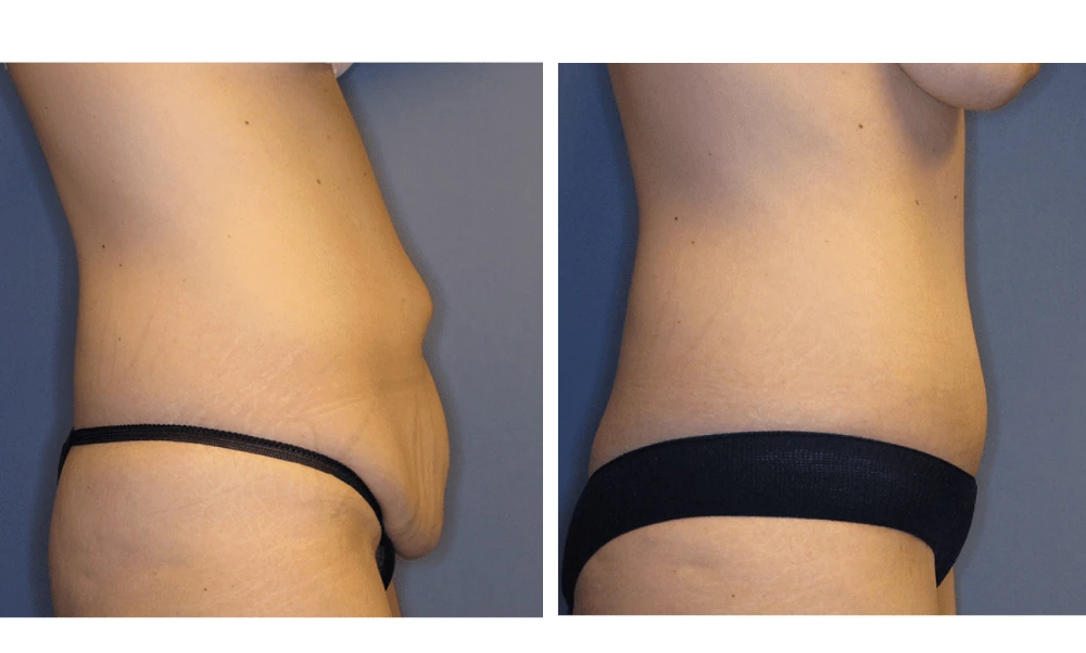 Tummy Tuck - Case 7 (2)