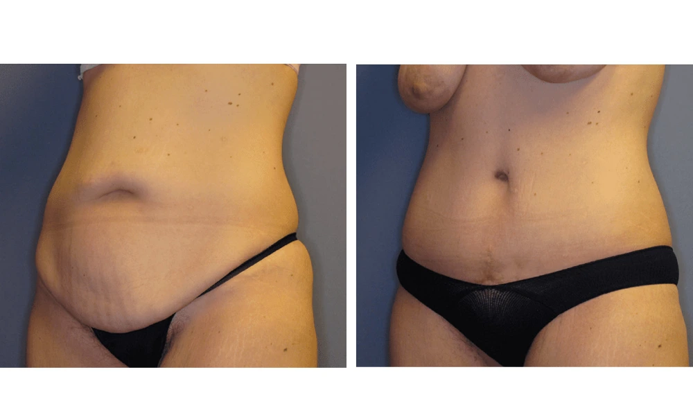 Tummy Tuck - Case 7 (3)