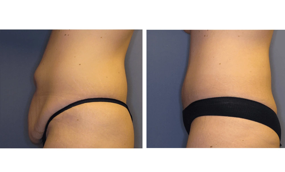 Tummy Tuck - Case 7 (4)