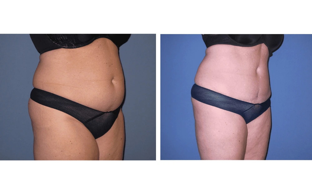 Tummy Tuck - Case 8 (1)