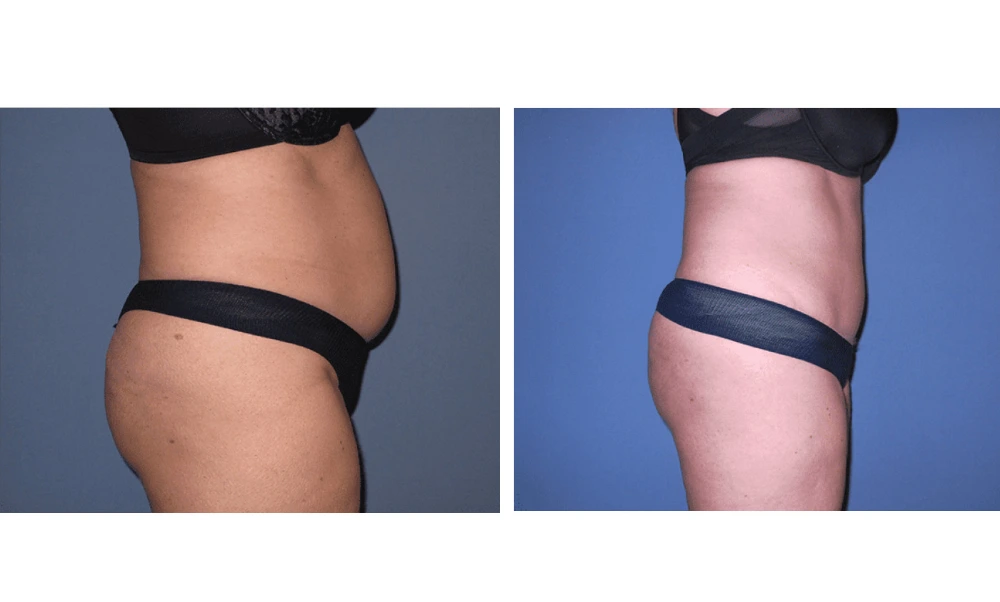 Tummy Tuck - Case 8 (2)