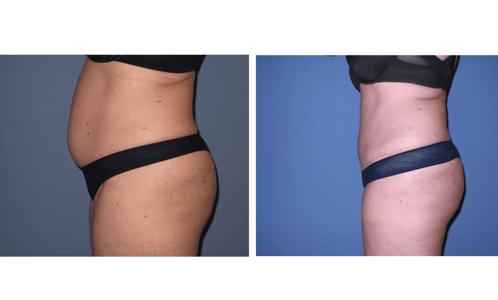 Tummy Tuck - Case 8 (4)