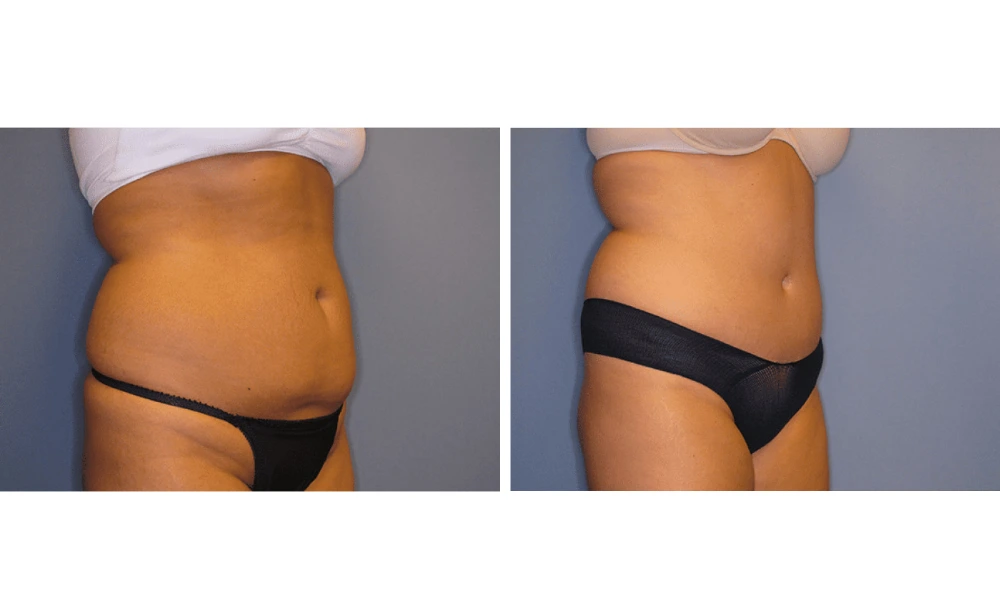 Tummy Tuck - Case 9 (1)