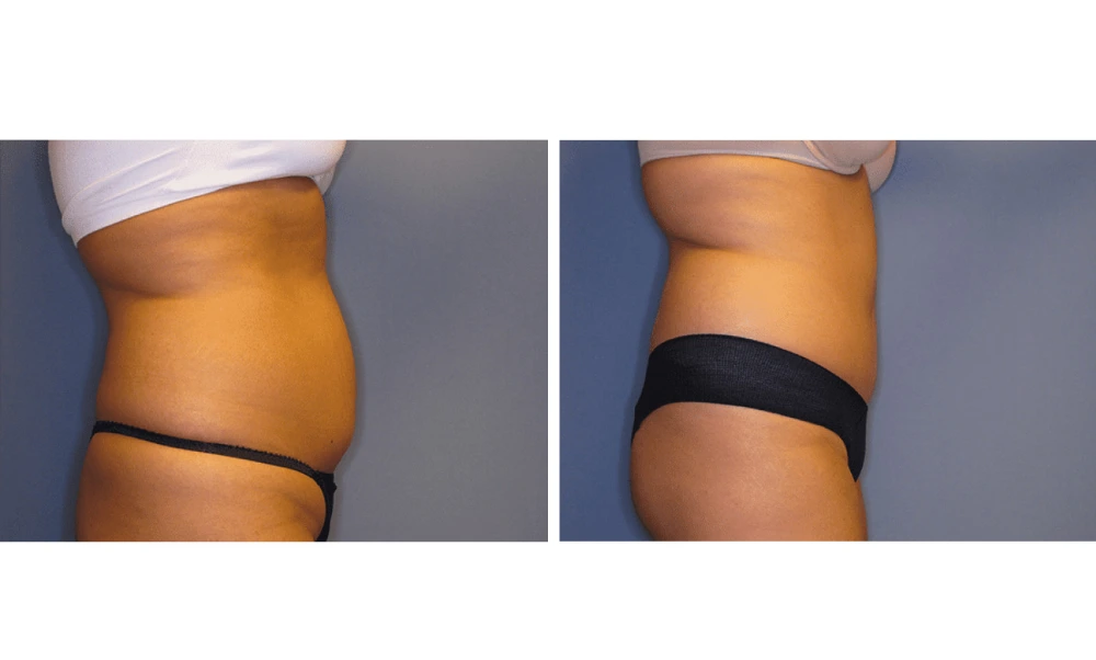 Tummy Tuck - Case 9 (2)