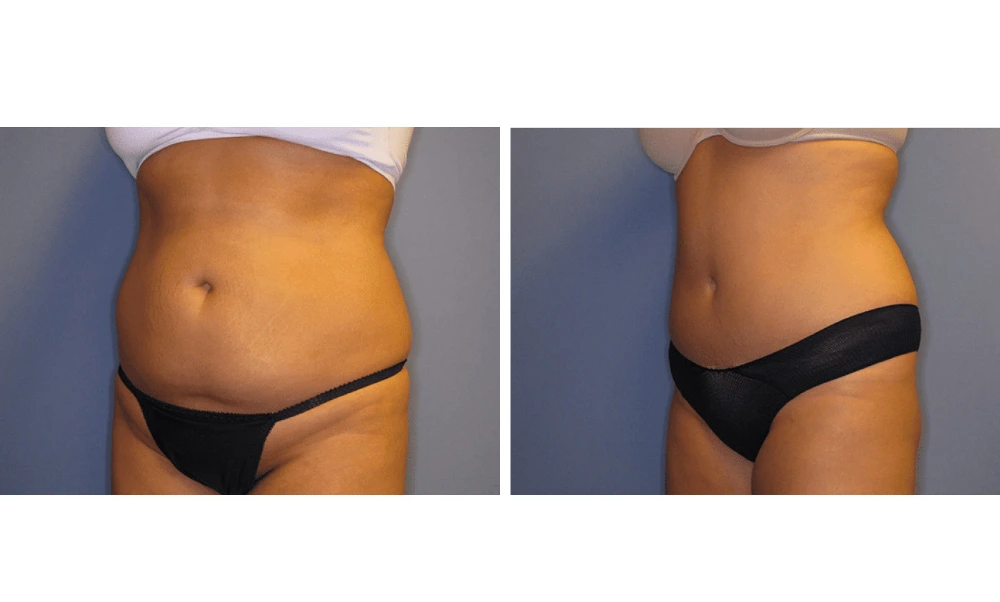 Tummy Tuck - Case 9 (3)