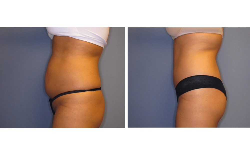 Tummy Tuck - Case 9 (4)