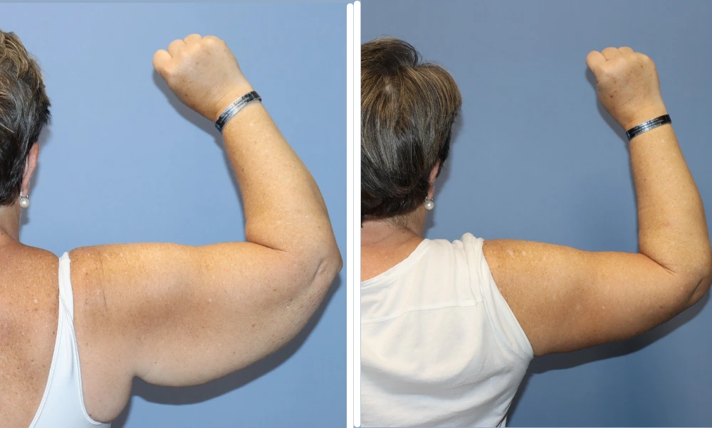 Patient's arm lift results shown from two angles with improved arm contour and skin tightness
