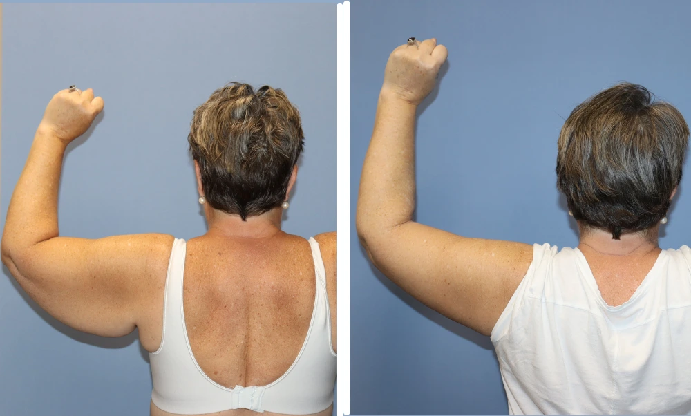 Arm lift before and after results showing improved arm contour and reduced sagging