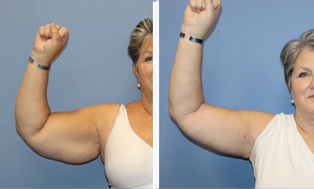 Arm lift before and after comparison showing reduced skin laxity and improved arm contour