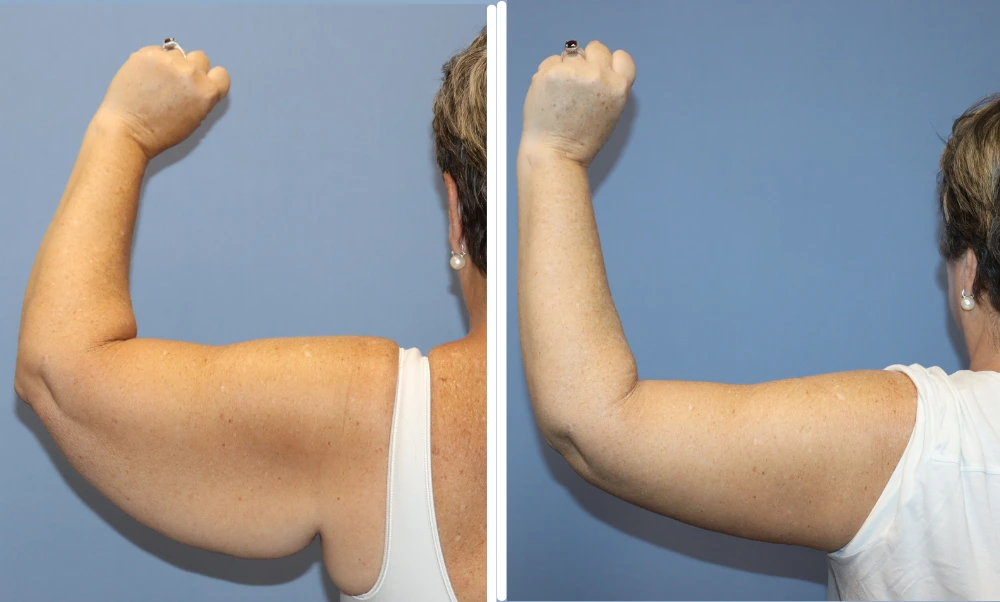 Arm lift before and after comparison showing patient's arm from side angle with improved contour and skin tightness