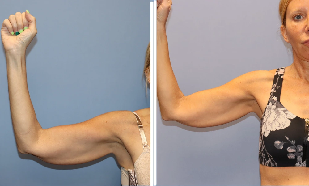 Patient demonstrating toned arm contour and definition after arm lift procedure