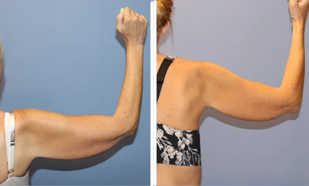 Patient's arm lift results showing toned upper arms from side and front angles