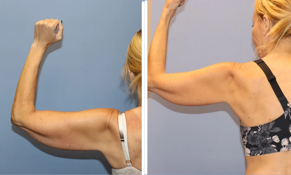 Patient displaying arm lift results with toned upper arms and improved skin firmness