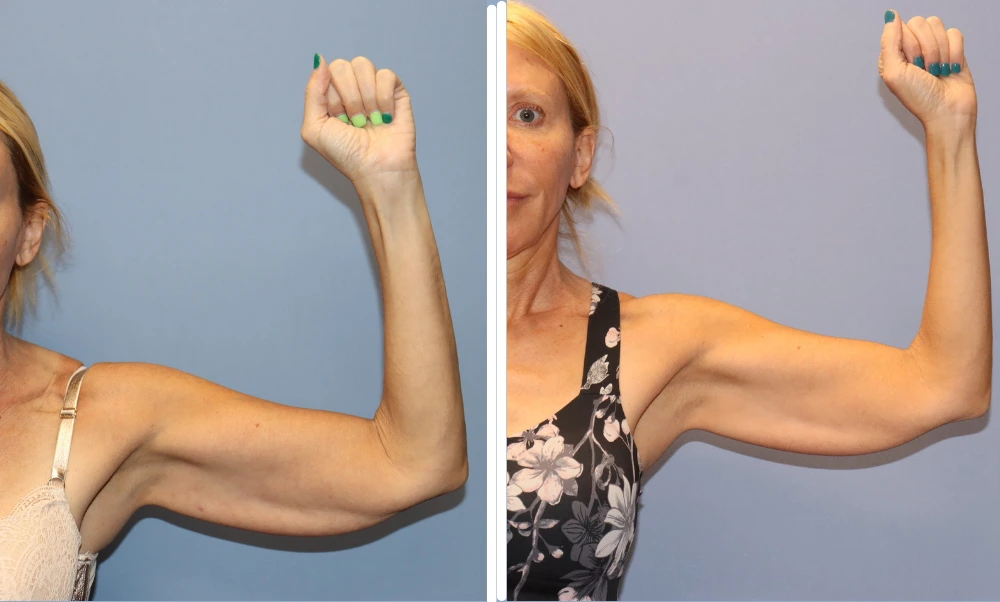 Arm lift before and after results showing improved arm contour and skin tightness