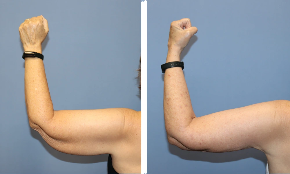 Before and after arm lift results showing reduced skin laxity and improved arm contour