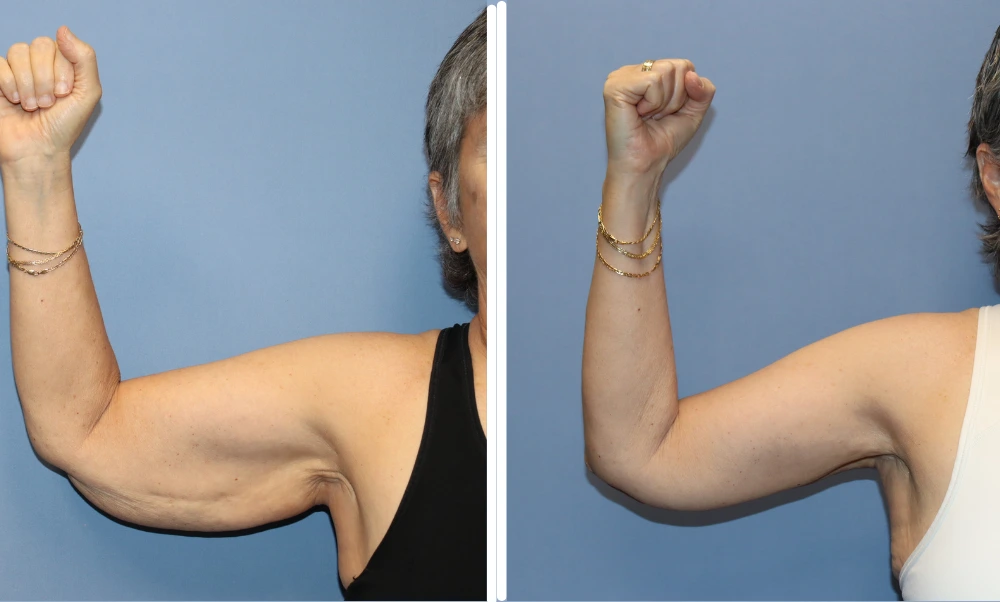 Before and after arm lift results showing improved arm contour and skin tightness