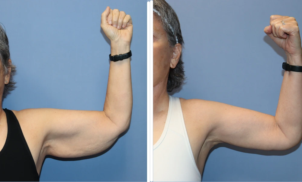 Arm lift before and after: patient's arms raised showing improved skin tightness and contour