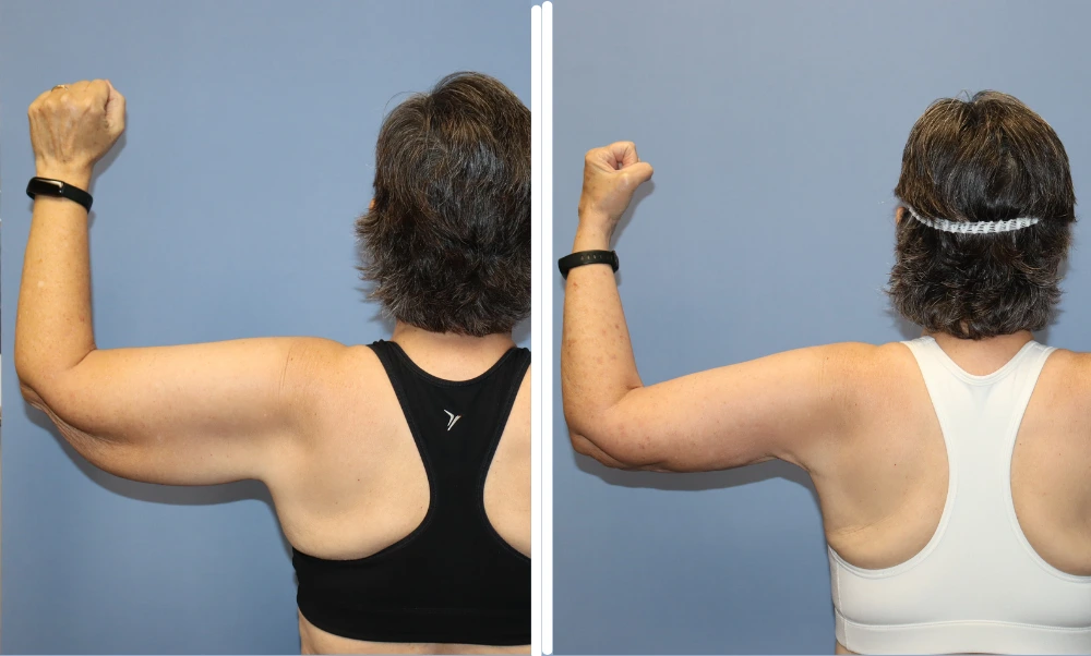 Arm lift before and after comparison showing improved arm contour and reduced loose skin