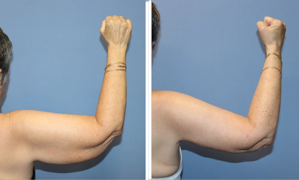 Before and after arm lift results showing improved arm contour and skin tightness