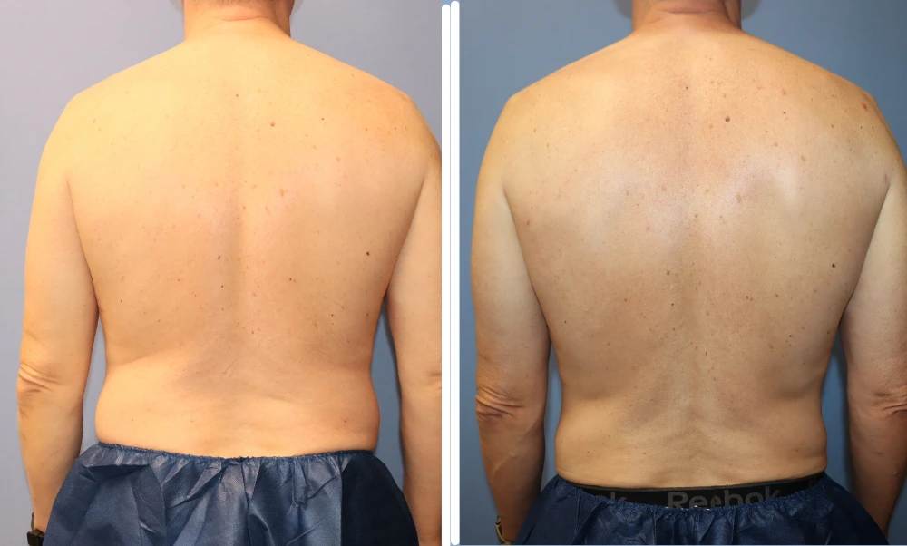 Before and after BodyTite treatment showing improved skin tightness and contour of the back and torso