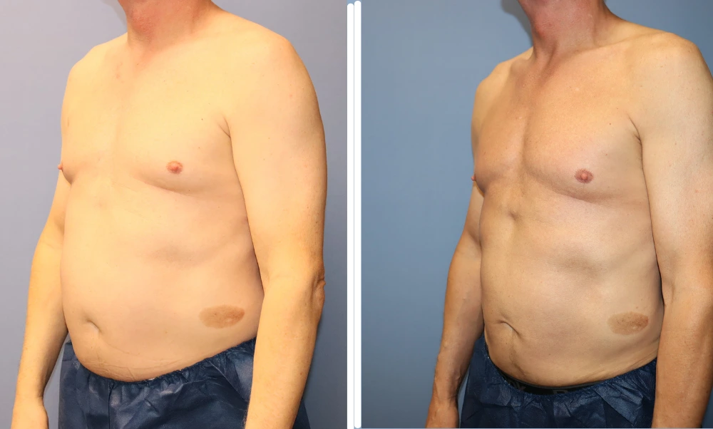 Male patient before and after BodyTite treatment showing improved abdominal contour and skin tightening