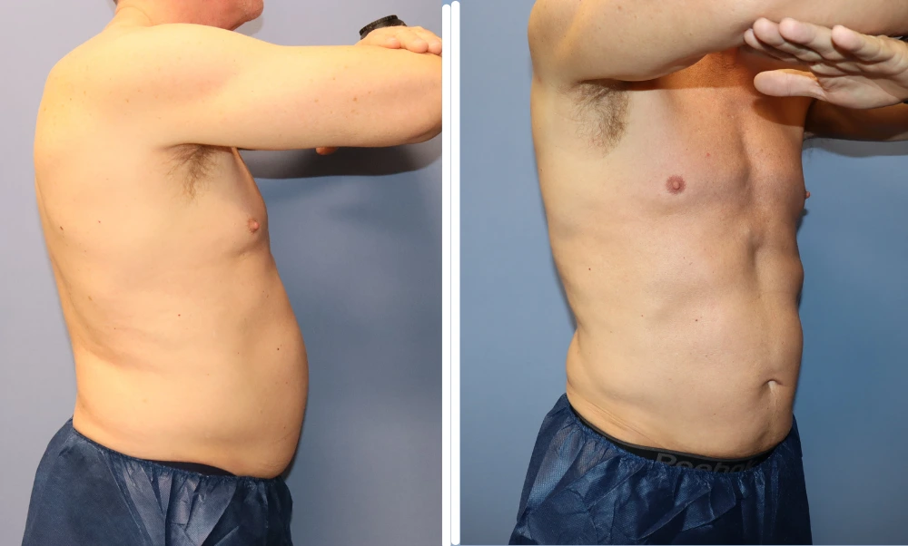Male patient's torso before and after BodyTite treatment showing improved body contouring