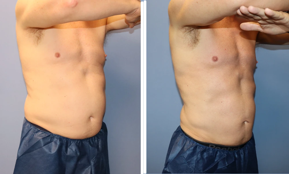 BodyTite before and after case: male patient's torso showing improved skin tightness and contour