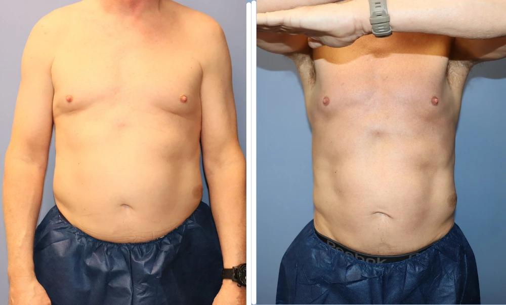 Male patient before and after BodyTite treatment showing reduced abdominal laxity and improved body contour