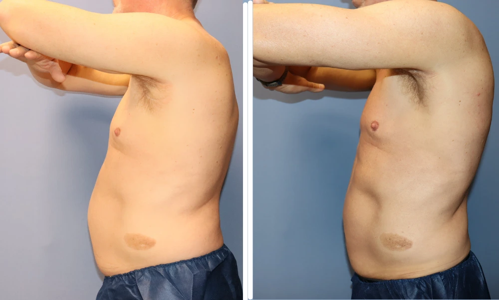 Male patient's torso before and after BodyTite treatment, showing improved skin tightness and contour