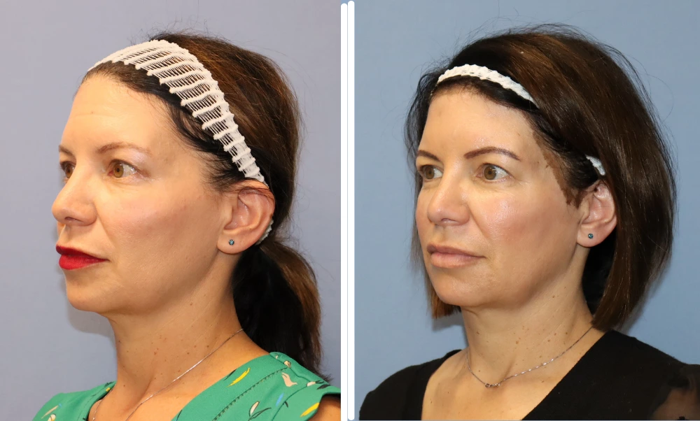 BodyTite before and after case 2: side-by-side profile views showing improved skin tightness and contour
