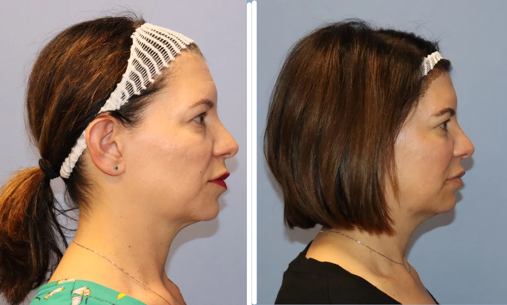 Before and after profile views of a BodyTite case showing improved skin tightness and definition