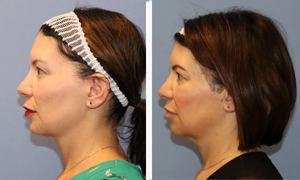 BodyTite before and after results showing patient profile with improved jawline and skin tightening
