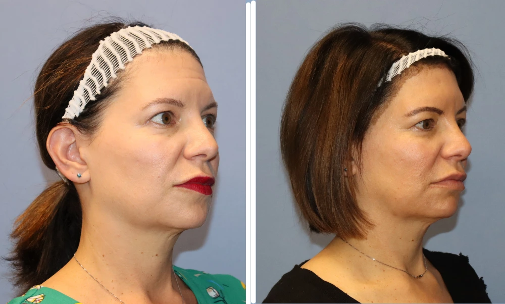 Before and after BodyTite treatment showing improved jawline and neck definition in profile view