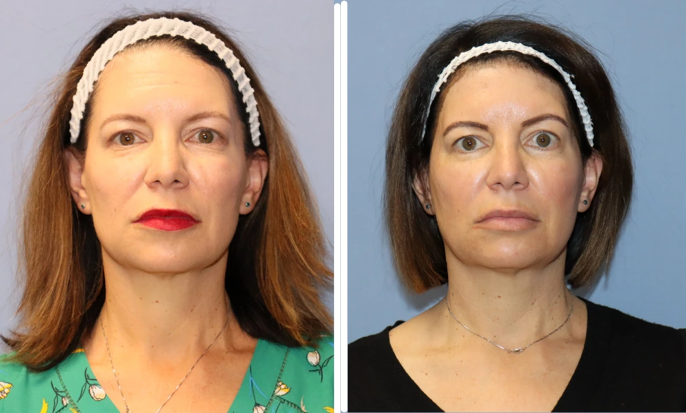 BodyTite before and after case 2: frontal view of patient showing facial contouring results
