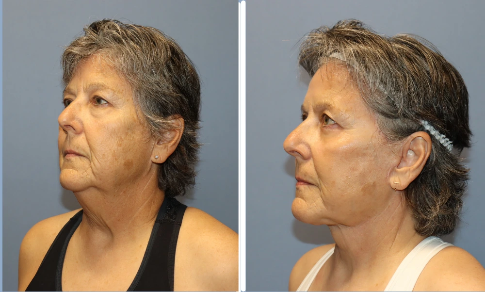 Facelift patient before and after, side profile view showing improved facial contour and skin tightness
